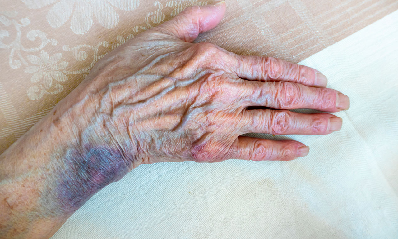 Close-up of an older adult’s hand showing visible bruising that may require medical attention and documentation